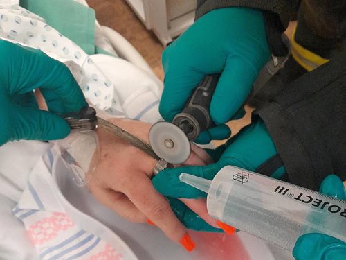 Hasiči pomohli před operací pacientce se sundáním prstýnku